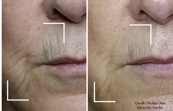 BioRePeel Vorher Nachher