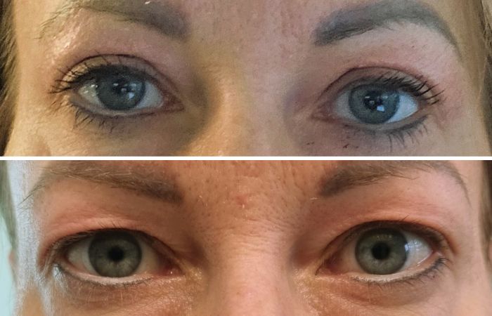 RF Needling Behandlungen Vorarlberg by Donella formt