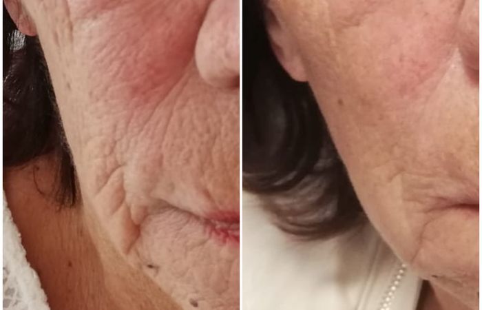 3D-HIFU Vorher Nachher