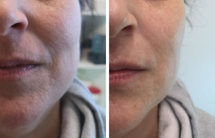 3D HIFU Vorher Nachher