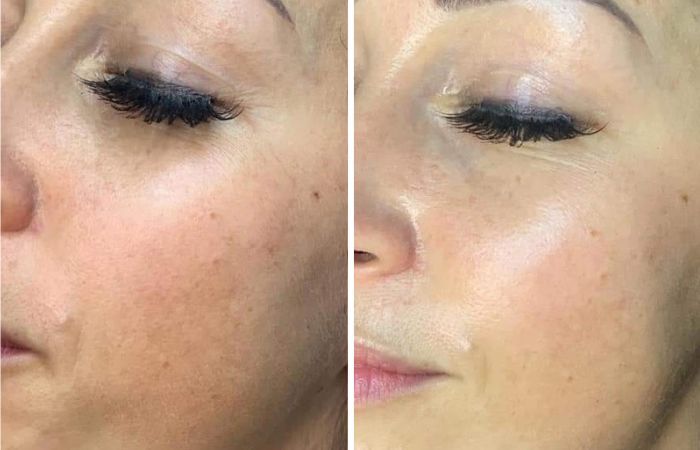 BB-Glow Vorher Nachher