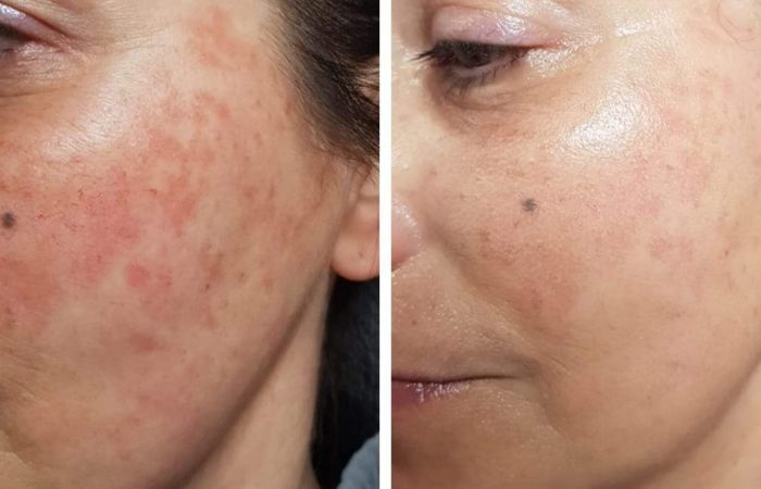 BB Glow Vorher Nachher