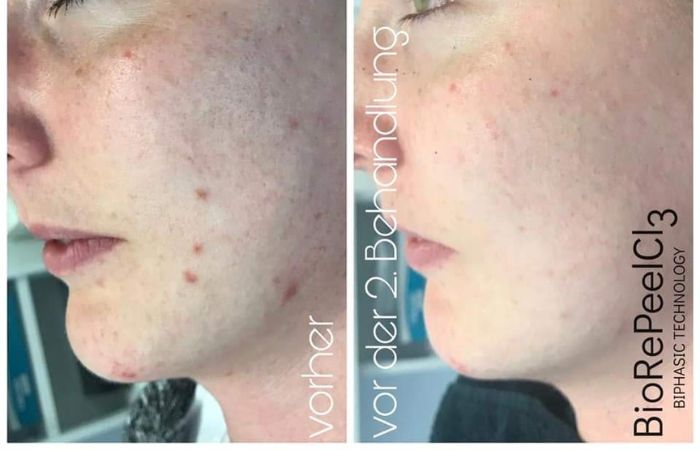 BioRePeel Vorher Nachher