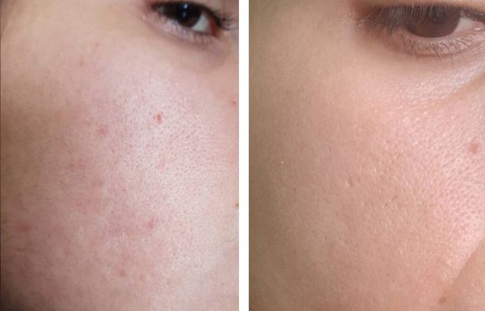 BioRePeel Vorher Nachher