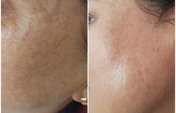 BioRePeel Vorher Nachher