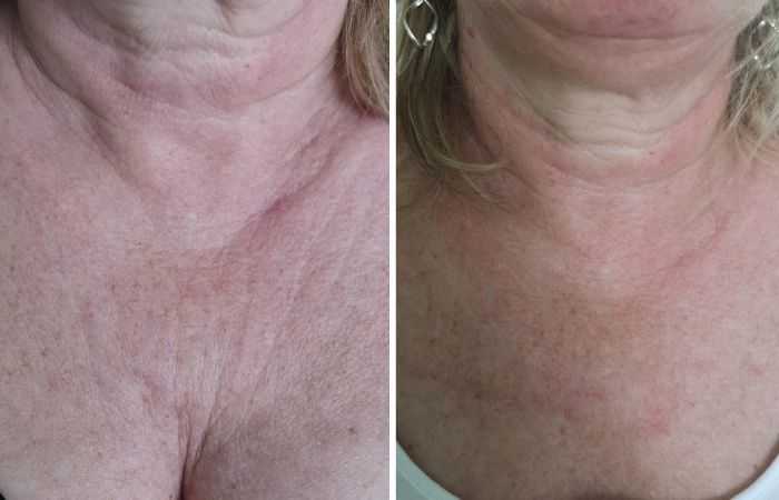 Notox und H100 Micro-Needling Vorher Nachher