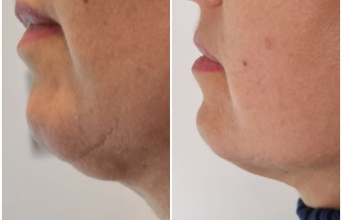 Microneedling und MesoLipo Vorher Nachher