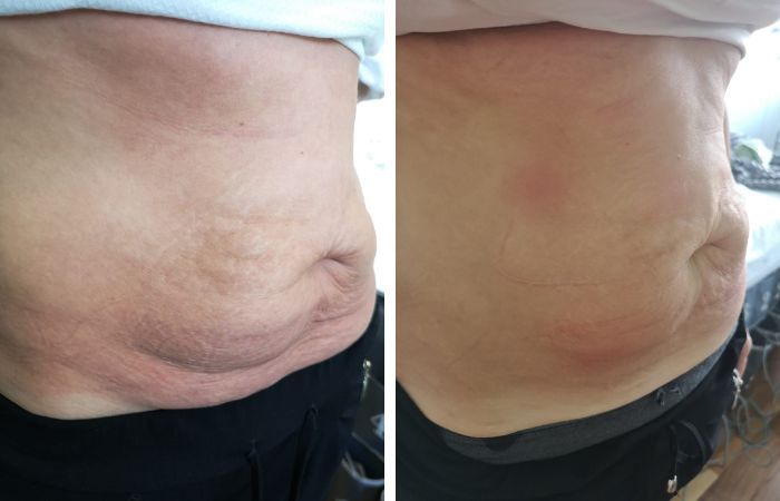 MesoLipo Vorher Nachher