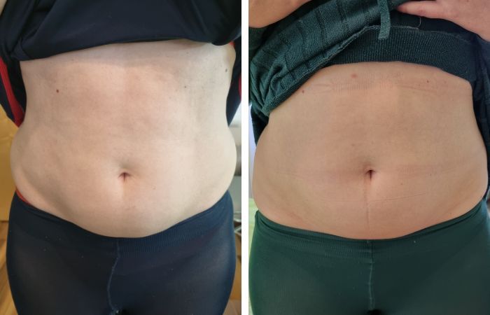 Mya3+ Vorher Nachher