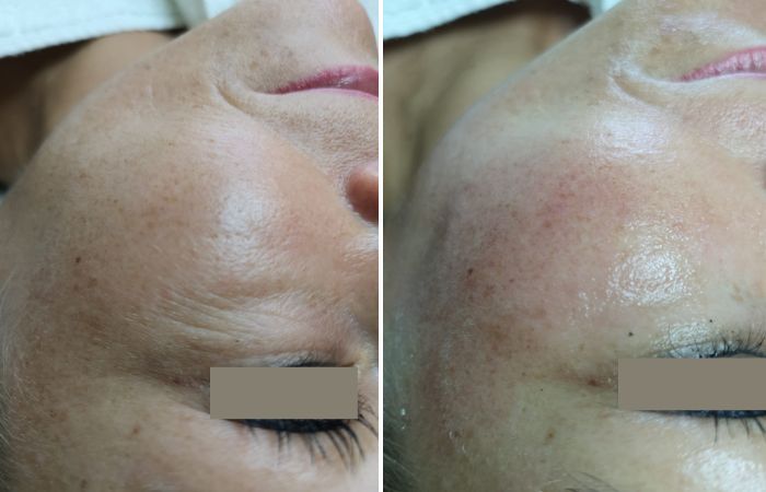 Notox und -H100 Micro-Needling Vorher Nachher