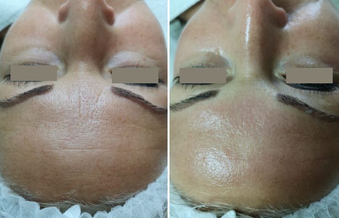 Notox und -H100 Micro-Needling Vorher Nachher