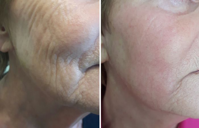 Plasma-Pen Vorher Nachher