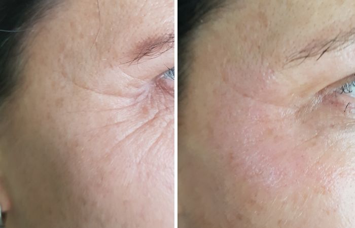 Plasma-Pen Vorher Nachher