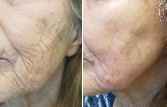 Plasma Pen Vorher Nachher