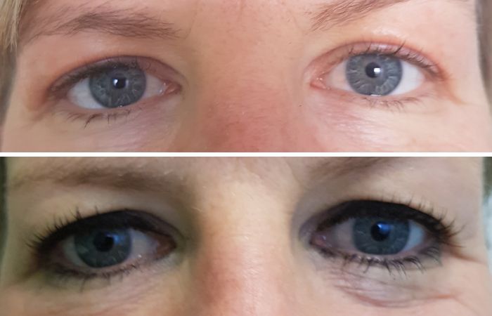 Plasma-Pen Vorher Nachher