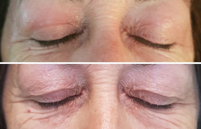 Plasma-Pen Vorher Nachher