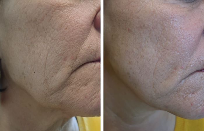 RF Needing Vorher Nachher