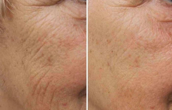 RF Needing Vorher Nachher