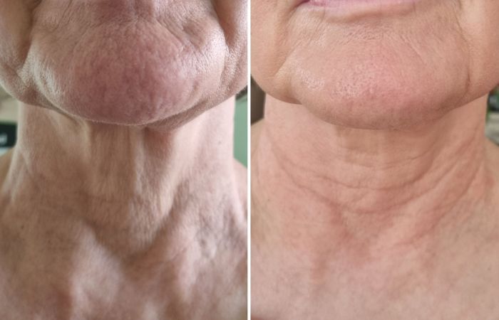 RF Needing Vorher Nachher