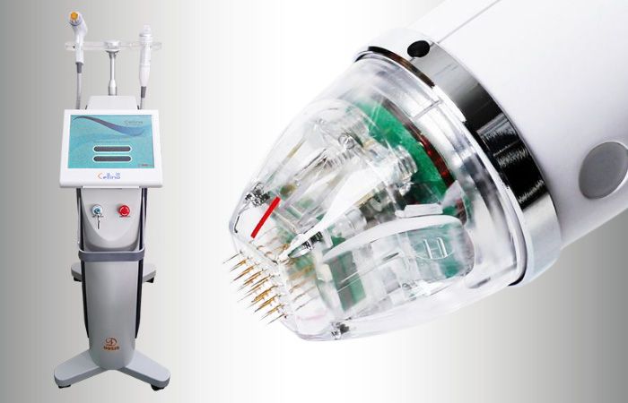 RF Needling Vorarlberg by Donella formt