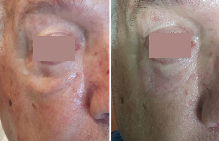 Plasma Vorher Nachher